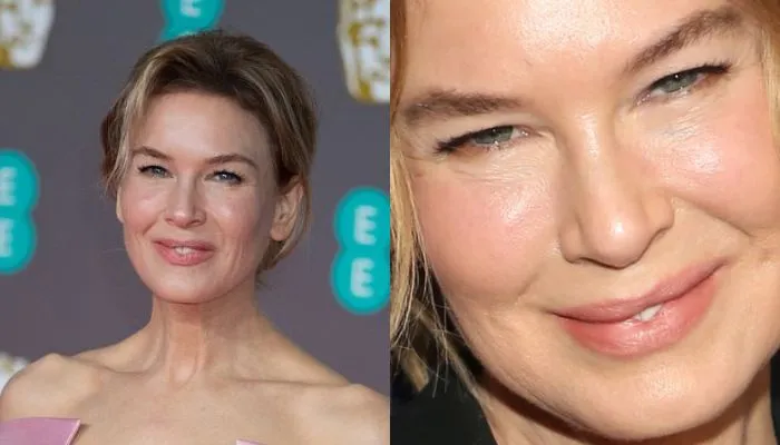 Side-by-side photos of Renée Zellweger highlighting her drastic facial change